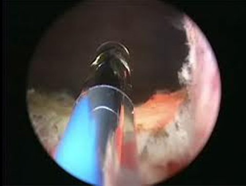 Laser Προστατεκτομή - Υπερπλασία του Προστάτη Laser Προστατεκτομή - Υπερπλασία του Προστάτη