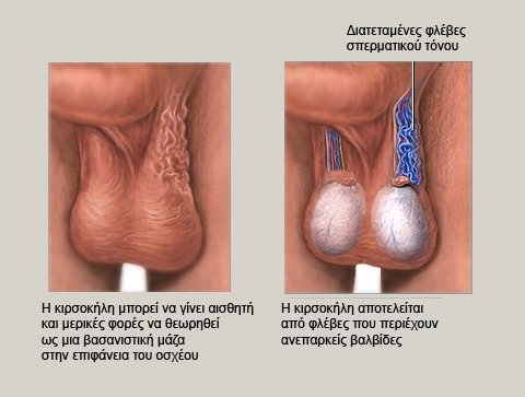 Ρομποτική Διόρθωση Κιρσοκήλης Απολίνωση Της Έσω Σπερματικής Φλέβας