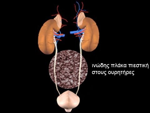 Ρομποτική Ουρητηρόλυση