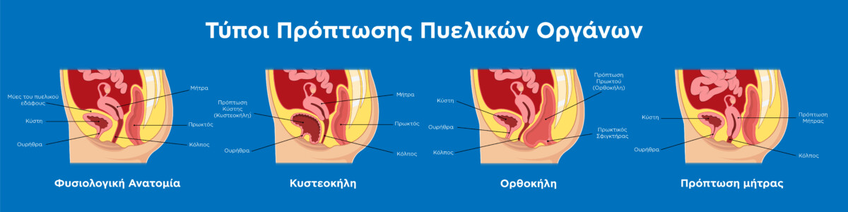Τύποι Πρόπτωσης (κυστεοκήλη, ορθοκήλη, πρόπτωση μήτρας) γεννητικών οργάνων